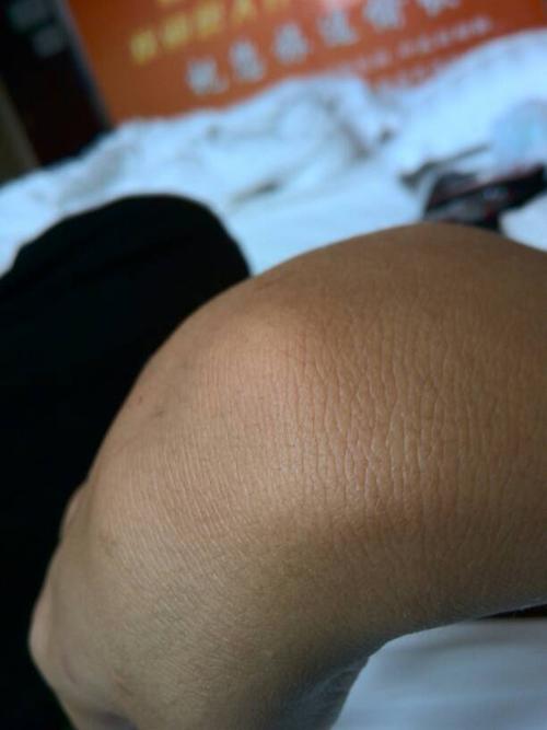 打架的时候拳头打歪了,手腕崴了一小,有点疼,然后过了半小时就不疼了