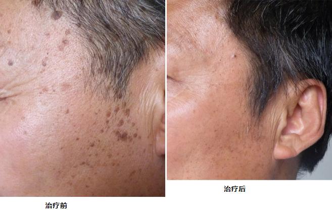 【科普】脸上常见的一种皮肤病,脂溢性角化!