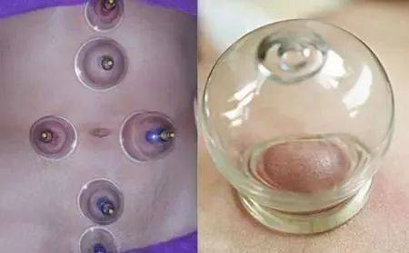 拔罐减肚子拔哪里图解 教你几种瘦身方式