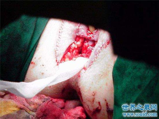 【图】金星自传描述变性手术过程 手术结束后体重少