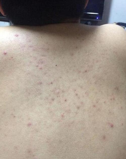 螨虫堵塞后背毛孔,最明显表现是痘痘疯长,来学3招除螨
