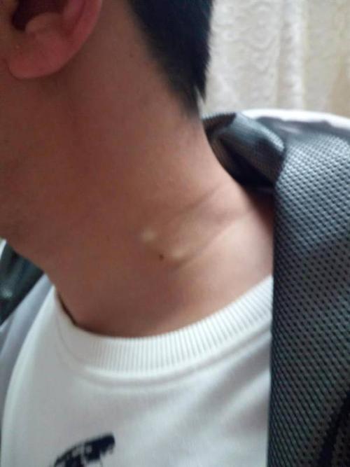 和家人聊天时脖子筋突然出现两个疙瘩,一会儿又消失了