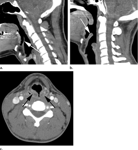 医影精品颈部ct影像分析及急诊报告要点