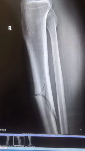 网曝建业新援右腿胫骨骨折首秀破门后遇重伤恐报销