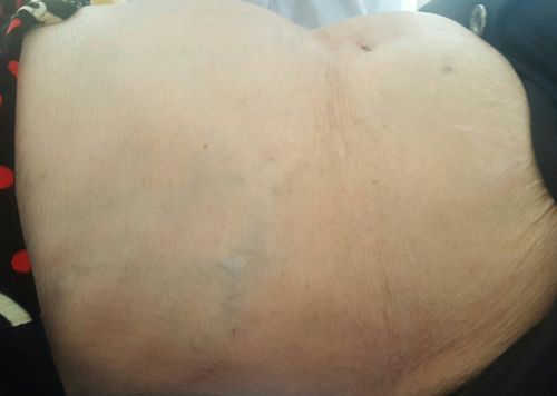 术后第二天腹壁静脉曲张基本消失,临床症状明显缓解