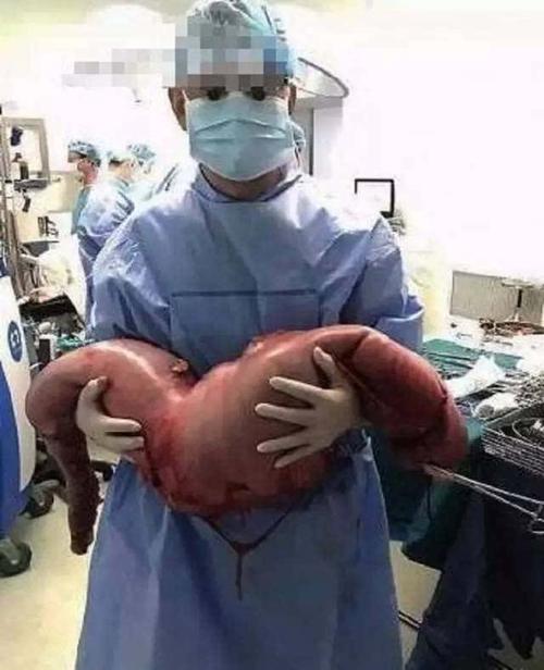认识先天性巨结肠