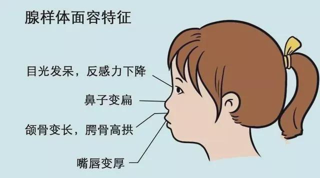 长期张口呼吸导致面容变丑?是真的!