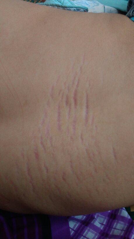 请皮肤专家我的小孩腰部有纹不痛不痒,这是怎么回事