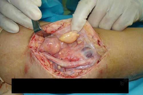 无力减轻,术后3周后,肘关节开始活动,随后肘部伤口内出现大量积液