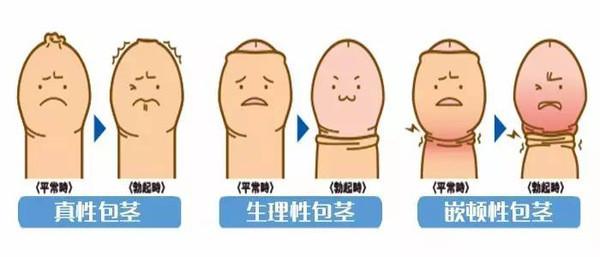 仁医微课堂丨秦超主任男科三部曲之一——包皮那些事儿