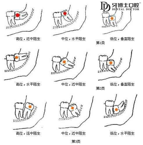 阻生智齿该不该拔