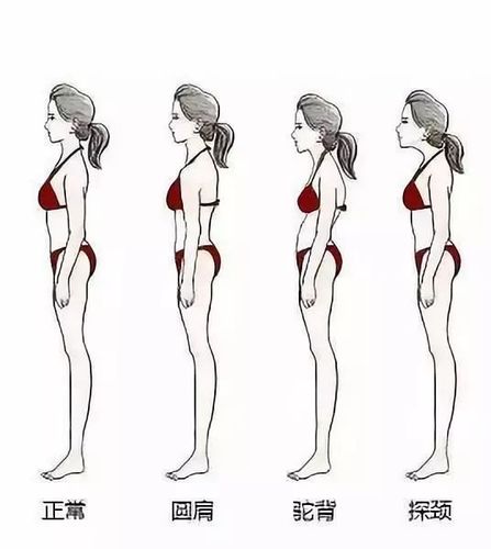 (正常体态和肩颈背的问题体态的对比)