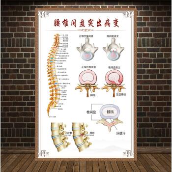 人体椎间盘常见病变颈椎脊椎息图骨骼挂图医院腰椎间盘突出墙贴 腰椎