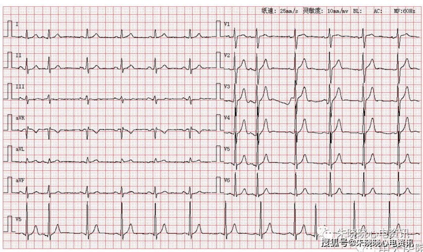 每日读图 || 第1076期 室早二联律_窦性