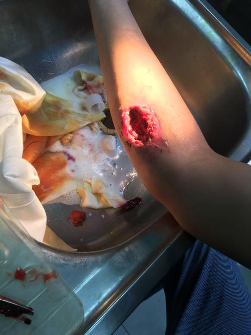 有什么药物能促进伤口愈合?手臂掉块皮很大很深一个月