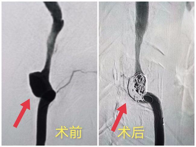 小伙头痛,颈痛确诊椎动脉夹层动脉瘤 专家巧施支架辅助弹簧圈栓塞解