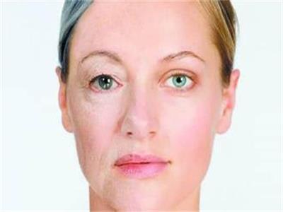 面部肌肉萎缩还能恢复吗