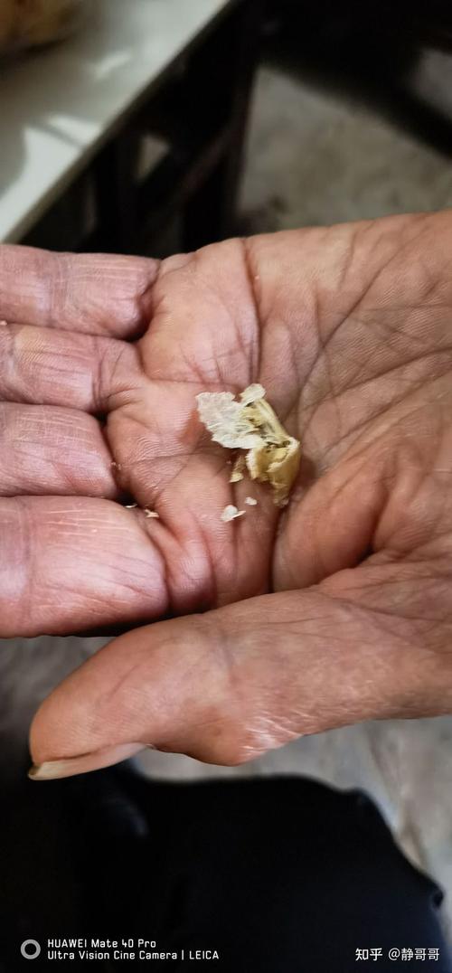 耳屎最大能有多大