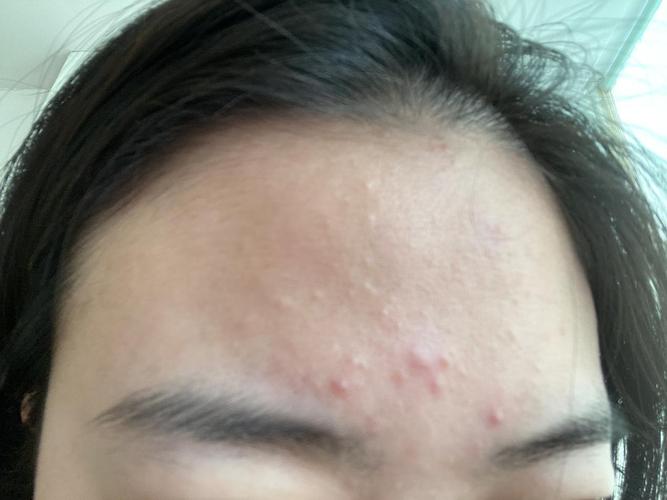 难道只有我眉心长痘吗!(慎入)