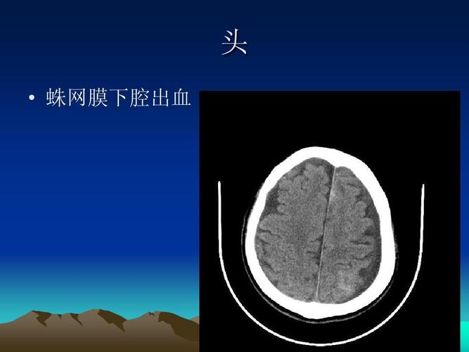 头   蛛网膜下腔出血