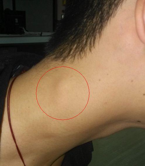 一个星期以前一觉睡醒后发现脖子后面长了俩疙瘩,并伴随着像睡觉时