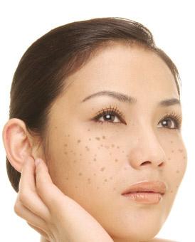 女人脸上长斑怎么办才好