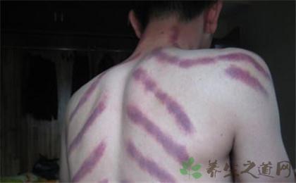 两则日记解读美女揪痧(2)