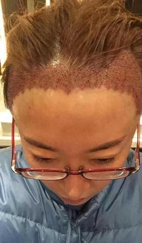 拯救大额头发际线植发2年了分享下经历