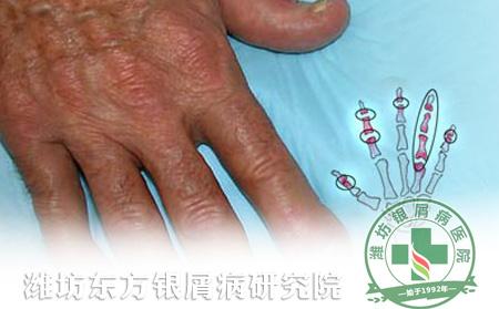 银屑病对关节的影响
