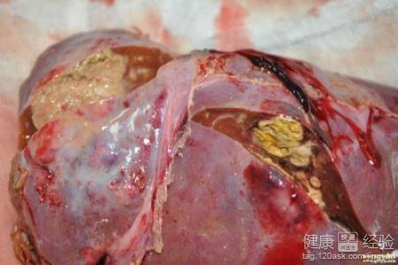 急性肝炎会不会传染