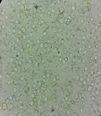 "看似简单"的肠道人芽囊原虫感染病例