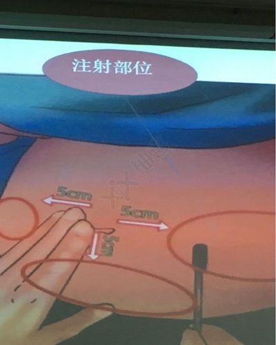 果纳芬的注射方式是皮下注射,最佳的位置是在肚脐的右侧,左侧或者