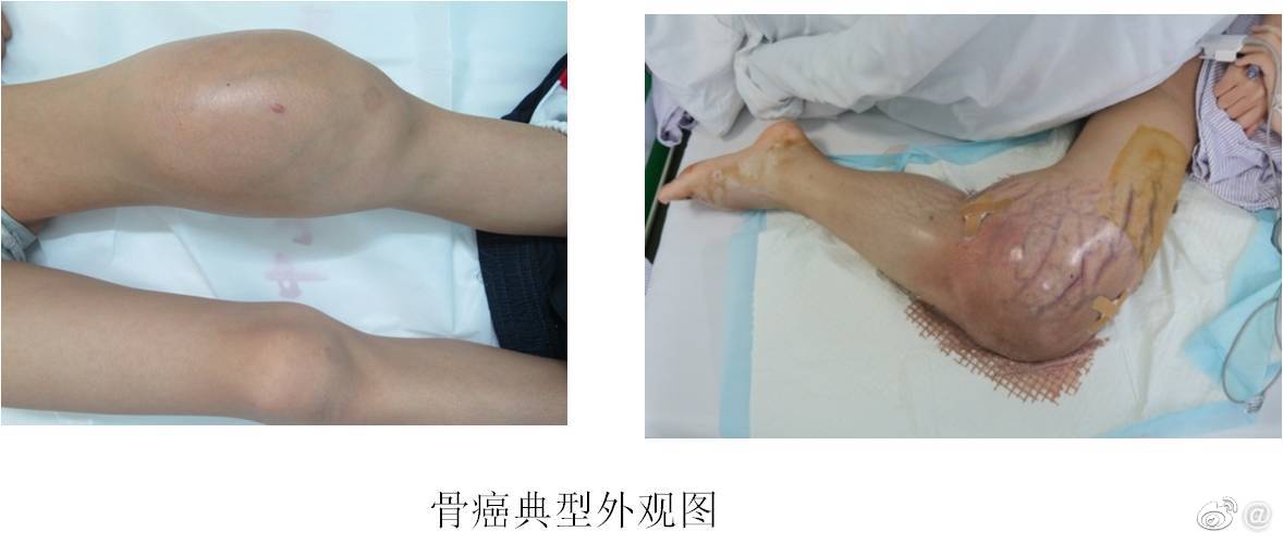 什么是骨癌?常见症状?