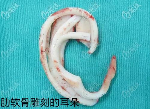 她表示自己的孩子先天小耳3度畸形,准备明年给做孩子肋软骨修复耳朵