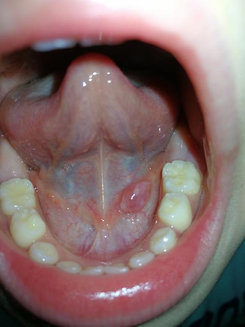 儿子舌头底下有个小肉芽,早就有,但是最近几天长大了