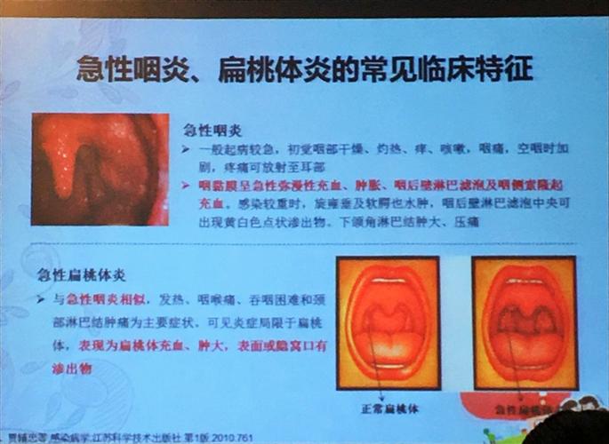 儿童急性咽炎扁桃体炎～唐兰芳