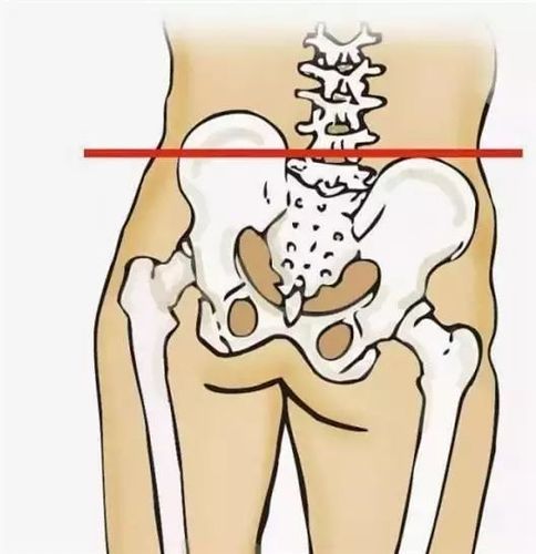 【女性健康】来测一测您的骨盆是否变形了