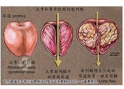 前列腺肿大