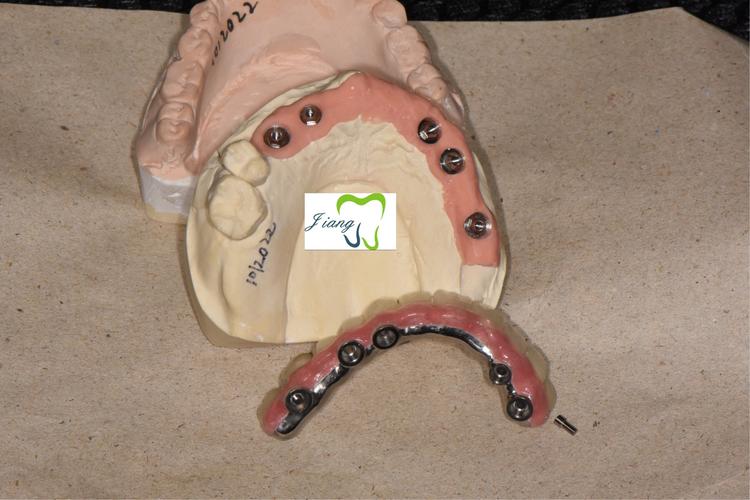 种植牙之纯钛多功能桥架 全瓷修复半口种植牙一例