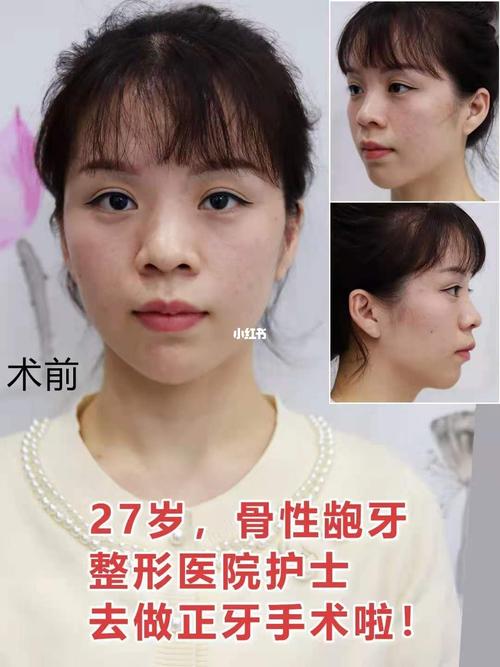 骨性龅牙凸嘴露龈笑矫正后减龄效果满分