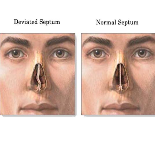 what is a deviated nasal septum