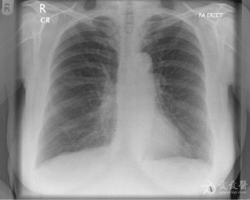一名 76 岁的女性,因"慢性阻塞性肺部疾病"前来就诊,她是重度吸烟者