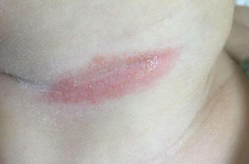 包括颈部,腋窝,大腿内侧,腹股沟等处,出现红色皮疹,甚至出现破溃皮