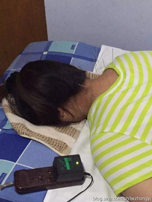 14副中药配合针灸治愈颈椎病