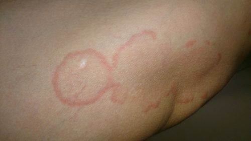 问:团状红斑,稍微有痒感,最大的有5mm,边缘稍微凸起.