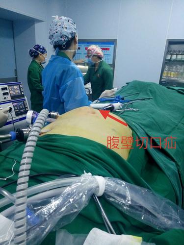 带你认识切口疝手术