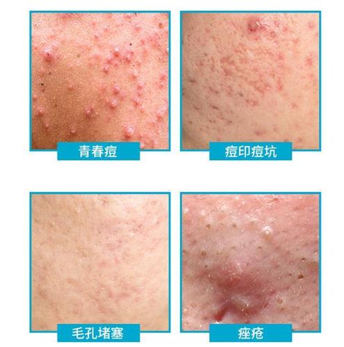 今天就来聊聊痘痘(痤疮)那点事儿.