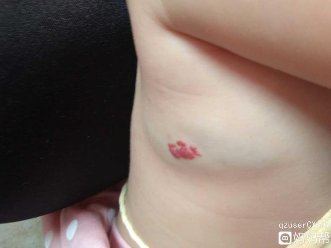 混合型血管瘤怎么治疗啊,昨天去医院看了医生让手术,我不想给她做孩子