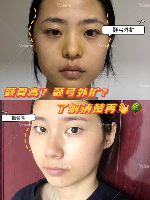 颧骨高?颧弓外扩?了解清楚再手术!