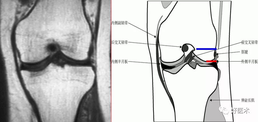 横韧带连接内外侧半月板前角,呈现低信号索带样结构 .